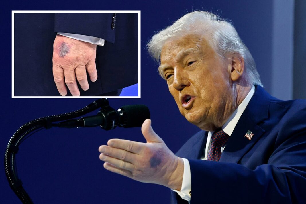 Large Bruise Noticed on Trump's Other Hand During Davos Speech